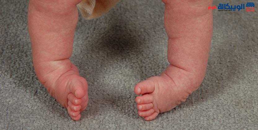 أسباب القدم المخلبية عند الاطفال وطرق علاجها 1