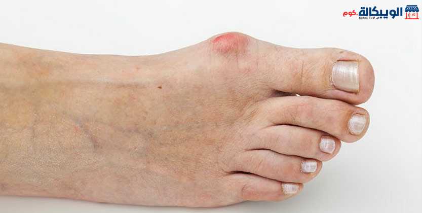 علاج اعوجاج ابهام القدم - السيليكون الطبي